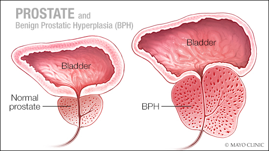 Benign Prostatic Hyperplasia (BPH): Causes, Symptoms, Prevention!
