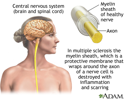 Multiple Sclerosis: Causes, Symptoms, Management