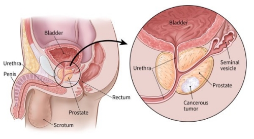 Cancer of the Prostate: Causes, Symptoms, Prevention!