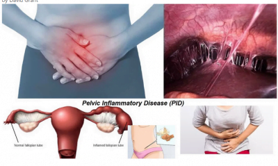 Pelvic Inflammatory Disease can be caused by a number of conditions like Infections.