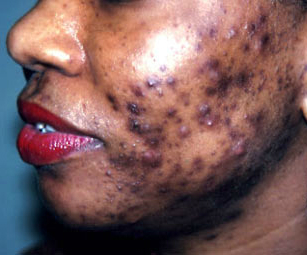 Acne (Pimples): Tips to Improve Your face