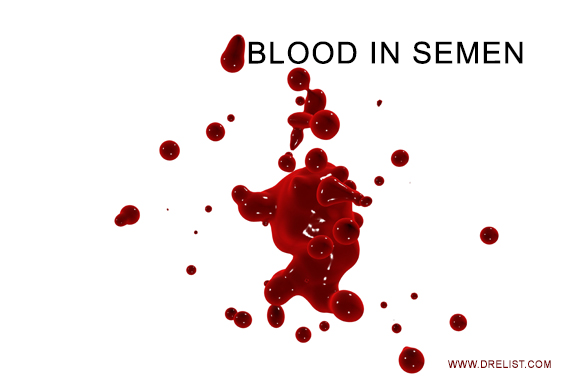 haematospermia is blood in semen