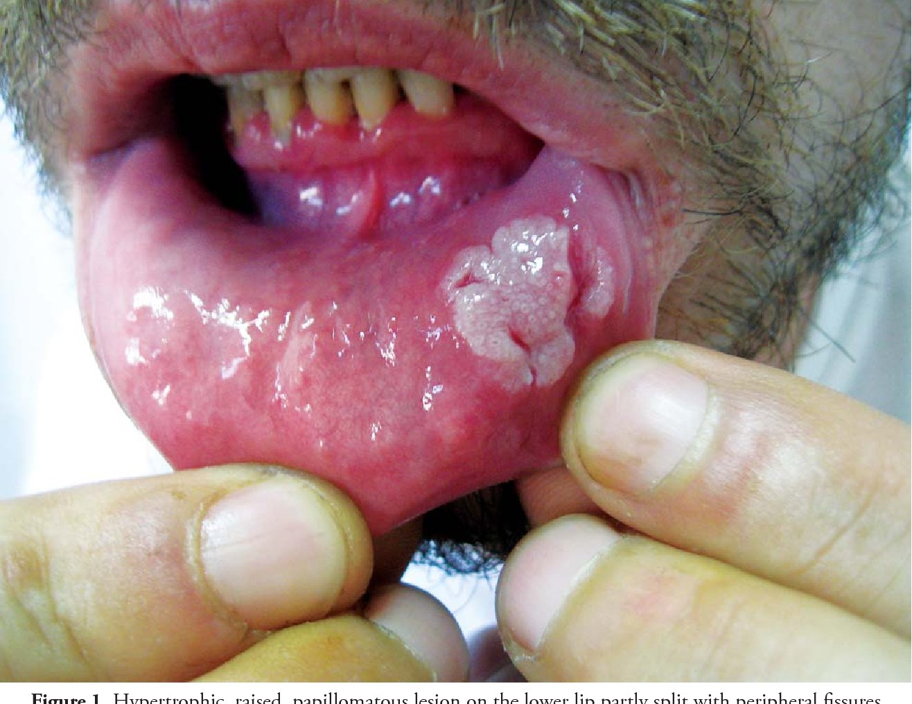Syphilis: Causes, Symptoms, Treatment, Prevention