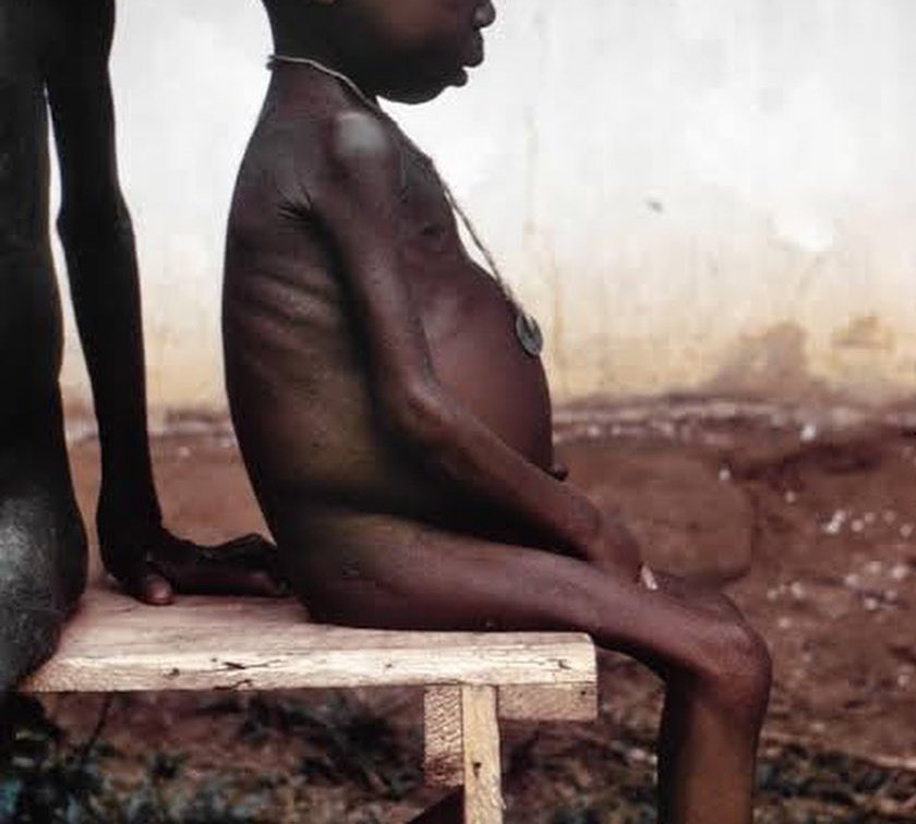 kwashiorkor malnutrition