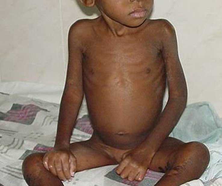 Marasmus malnutrition