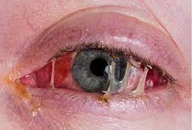 Common Eye Infections: Causes, Treatments