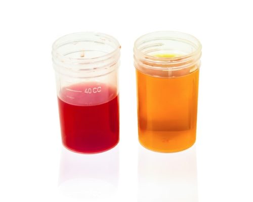 Different Urine Colour: causes & what it means