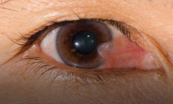 Eye Swelling/Bumps/Growths: Causes, Treatment