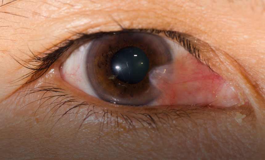 Eye swelling Pterygium