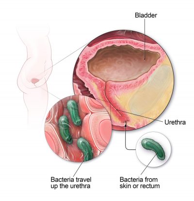 Urinary Tract Infection, UTI: Causes, Symptoms, Treatment