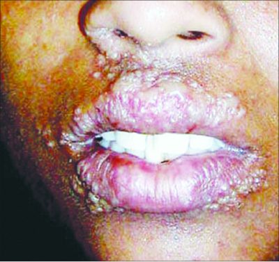 Cold Sores/Mouth Ulcers: Causes, Tips to manage it