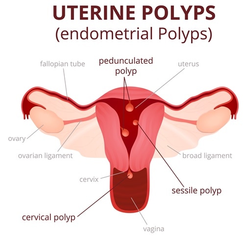 Endometrial Polyps: causes, symptoms, treatment