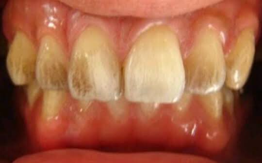 Tooth Discoloration/Stain: Causes, Treatments