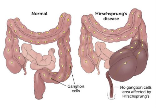 Hirschsprung’s Disease: Cause, symptoms, Treatment
