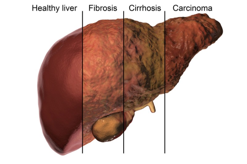 Liver Cirrhosis: Causes, Symptoms, Treatment