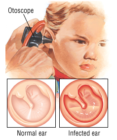 Otitis Media (Middle Ear Infection): Causes, Symptoms