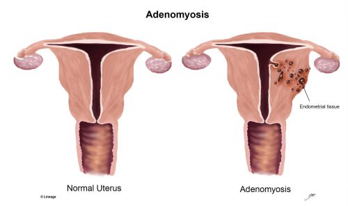 Adenomyosis: Causes, Symptoms, Treatment