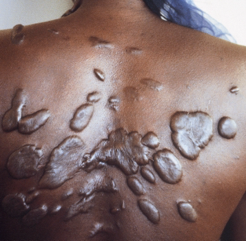 Keloids (large scars on the skin): causes, prevention
