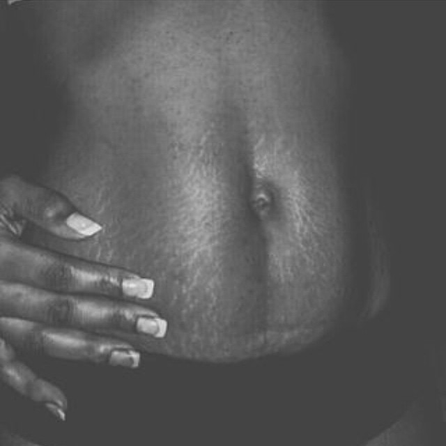 Stretch Marks: Causes, How to Treat it