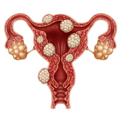 Endometriosis: Causes, Symptoms, Treatment